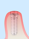インプラントの埋入